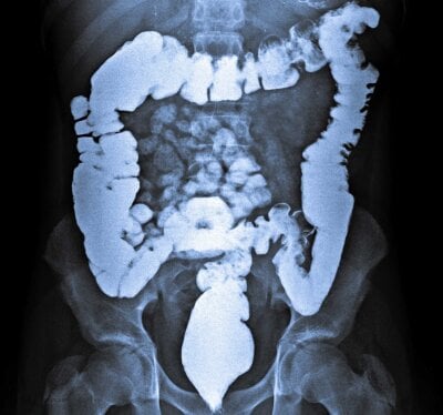 Tøntgenbilde av tarmene inne i et menneske